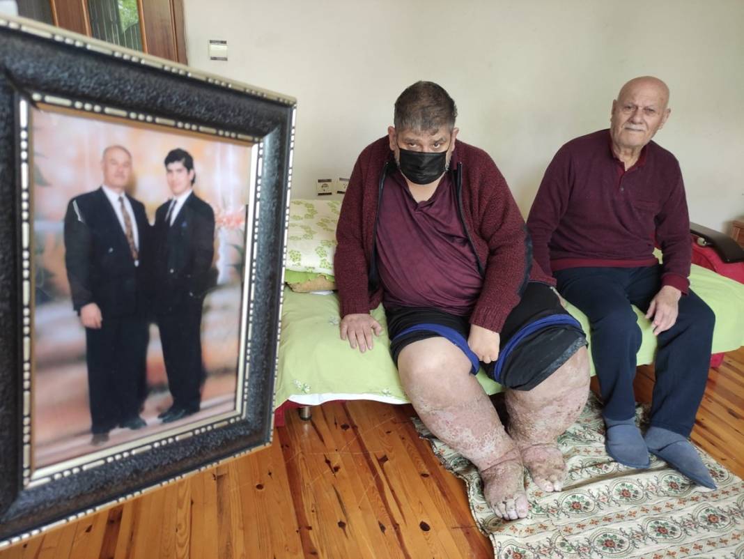 Sivrisinek, hayatının kabusu oldu! Öyle bir hastalığa yakalandı ki doktorlar çaresiz kaldı 2